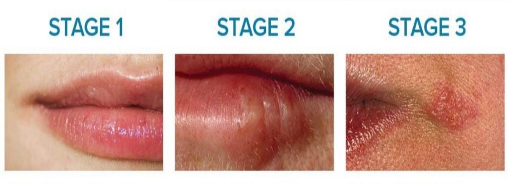 beginning of a cold sore