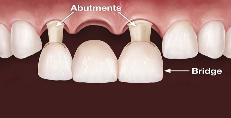 Zubní můstek - Kosmetická stomatologie - Zubní lékař v Royal Palm Beach