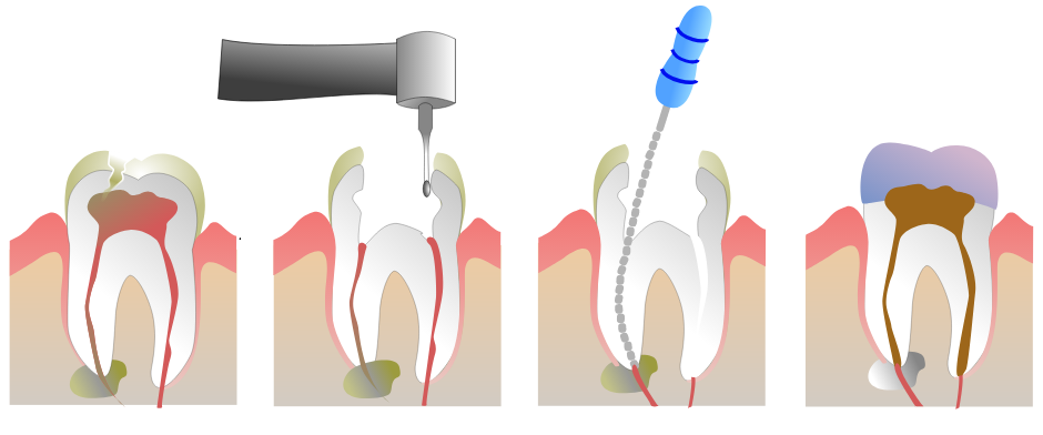 Root-Canal-royal-palm-beach