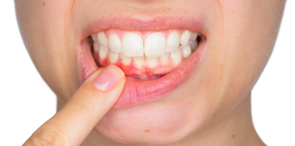 Causes of bleeding gums